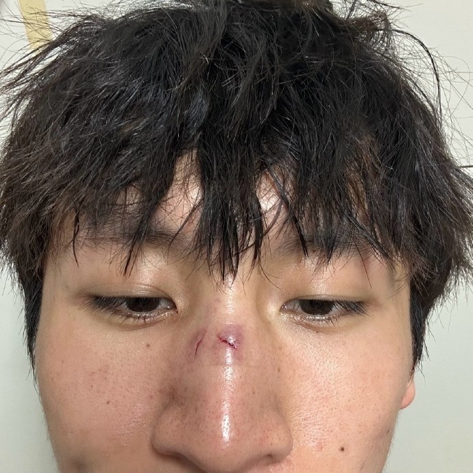 记者:为做好可能被国足征召的准备,谢维军决定暂缓做复位手术